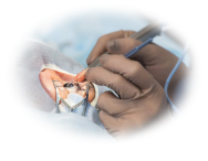 Cataract Surgery