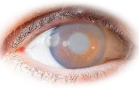 Glaucoma Surgeries